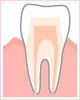 1．初期の虫歯