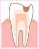 3．神経に近い虫歯