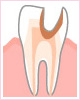 4．神経に達した虫歯
