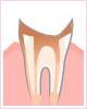 5．歯が崩れた末期の虫歯