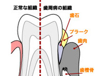 歯周病とは