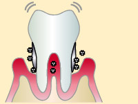 4．重度歯周病
