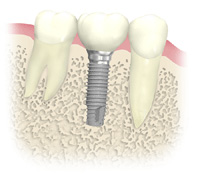 インプラント治療とは
